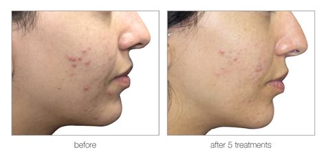 IPL Dual Acne .